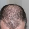 Studie zeigt: 100% Kürbiskernöl hilft gegen genetisch bedingten Haarausfall